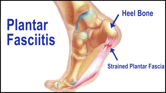 Plantar fasciitis pain