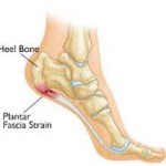 What is Plantar Fasciitis