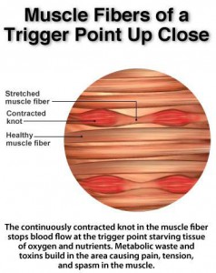 Muscle fibers trigger point up close