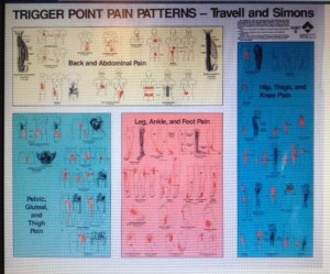 Trigger point referral pain chart